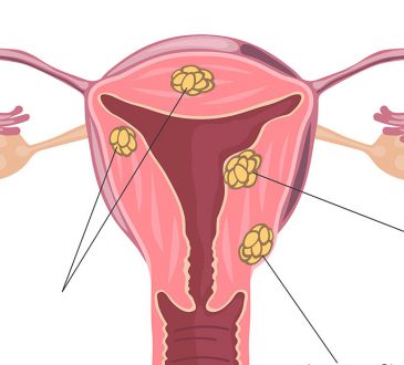 fibrom