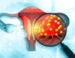 endometrium kanseri evreleri