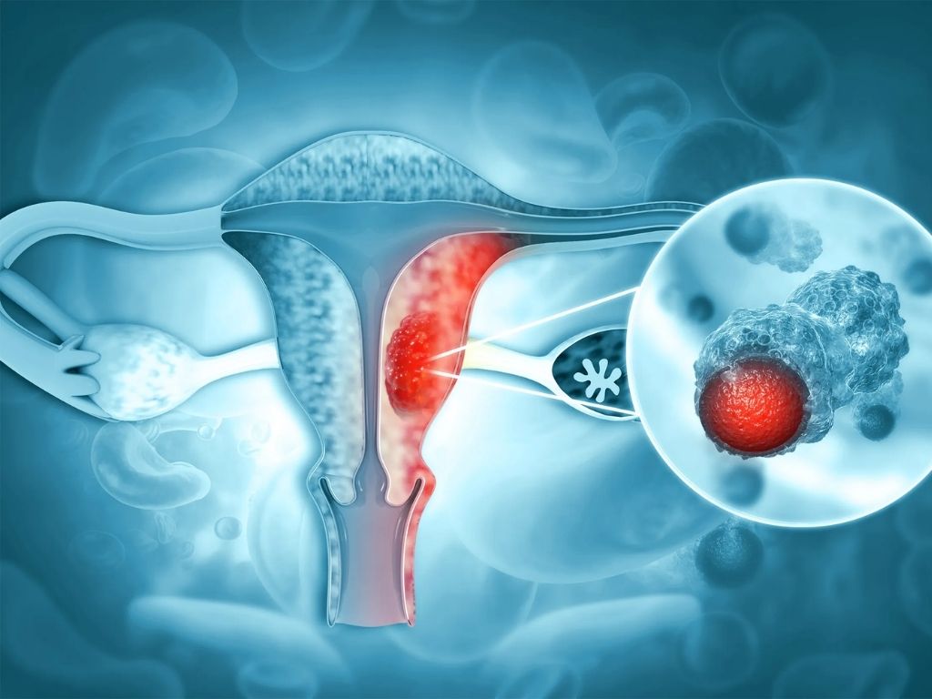 Endometrium Kanseri Evreleri